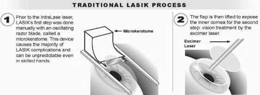 Traditional LASIK