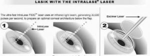 LASIK with Intralase