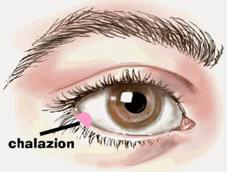 Chalazion