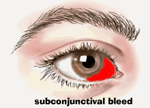 blood spot in eye